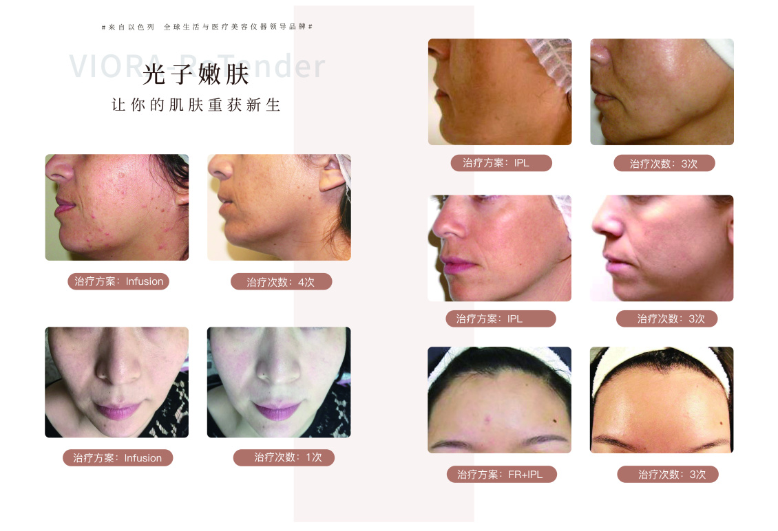 淘寶美工楊輕輕光子嫩膚手冊(cè)作品